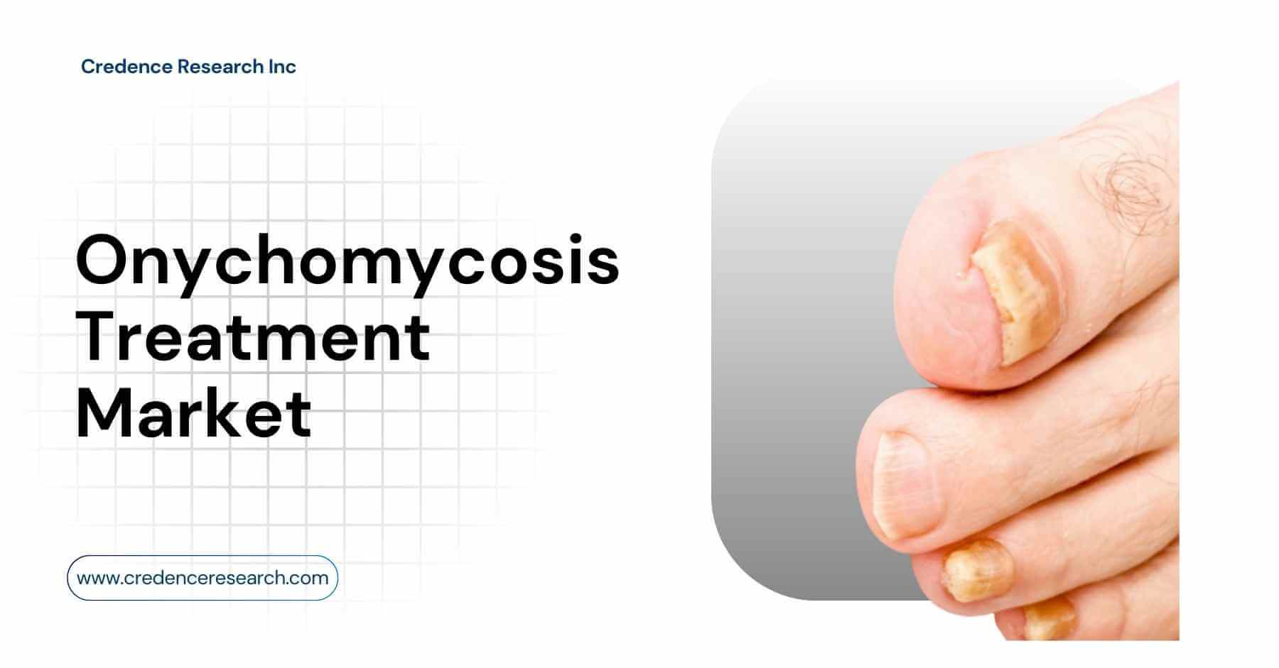 Onychomycosis Treatment Market to Reach USD 6.13 Billion by 2032