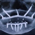 Zygomatic and Pterygoid Implants