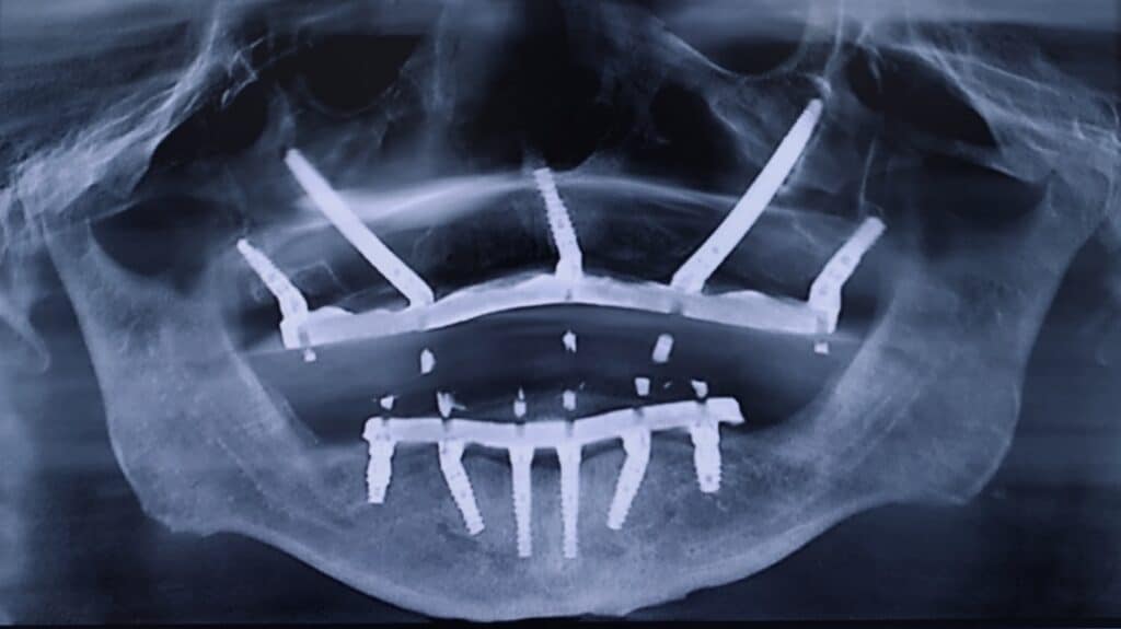 Zygomatic and Pterygoid Implants